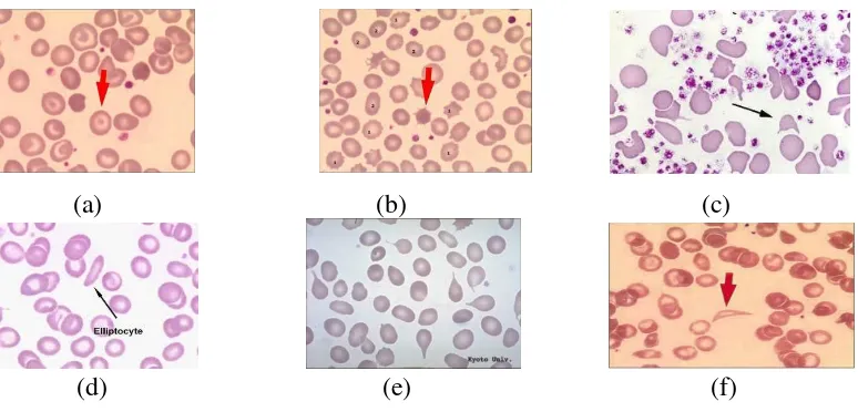Gambar 2.2. Jenis sel darah merah abnormal: (a) Target Cell, (b) Akankosit, (c) Helmet 