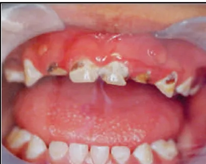 Gambar 1. Severe Early Childhood Caries 3