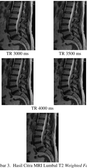 Gambar 2.Contoh Pemberian ROI pada citra Corpus  Vertebrae, Discus Vertebrae, Cerebro Spinal Fluid 