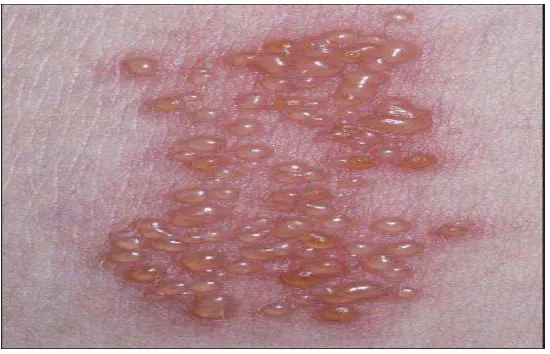 Gambar 1. Vesikel pada kulit yang disebabkan oleh infeksi herpes zoster. (Jhonson RW, Dworkin RH
