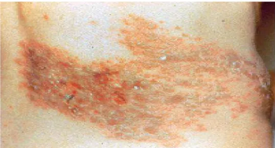 Gambar 2. Herpes Zoster pada kulit perut kanan. Beberapa lesi telah mengering. Lesi tersebut tidak melewati mid line
