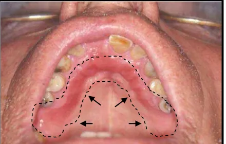 Gambar  5. Eritema difus dan edema  terbatas           pada   daerah   mukosa    palatum         (tanda panah)55 