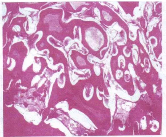Gambar 8.  Photomicrograph dari odontoma complex menunjukkan campuran        yang berbahaya dari jaringan gigi yang matang pada stroma jaringan ikat fibrous 12 