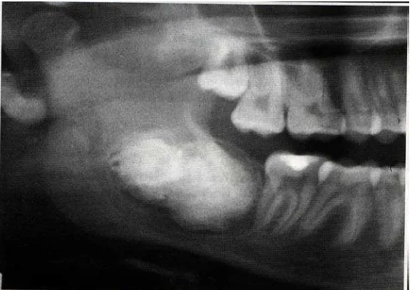 Gambar 10.  A & B, Serangkaian odontoma complex.  Perhatikan kerapatan struktur internal, kapsul radiolusen tipis yang menyebabkan terganggunya erupsi gigi yang terlibat1  