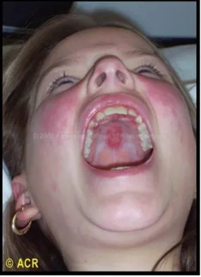 Gambar 2. Ulser oral pada pasien SLE  31 