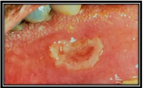 Gambar 3. Gambaran klinis ulser di lidah pada pasien leukemia akut. (Greenberrg MS, Glick M