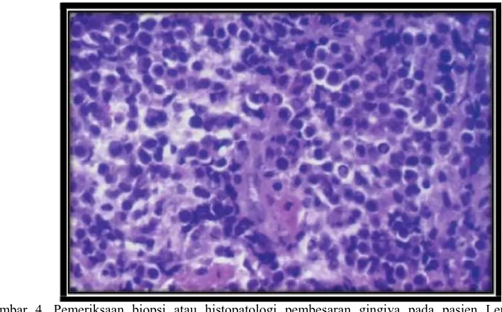 Gambar 4. Pemeriksaan biopsi atau histopatologi pembesaran gingiva pada pasien Leukemia  Mielomonositik Akut menunjukkan sel-sel leukosit monocytoid dalam jumlah besar 