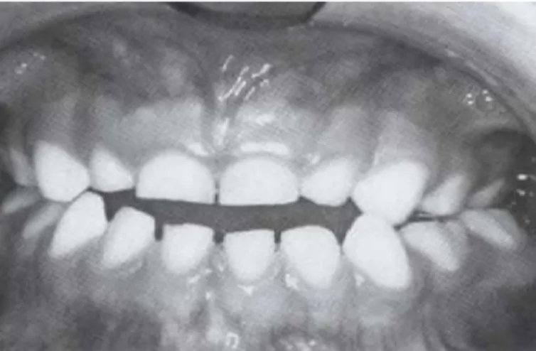Gambar 3: Open Bite (Sumber : Bishara. Samir E. Textbook of Orthodontics. W.B Saunders Company