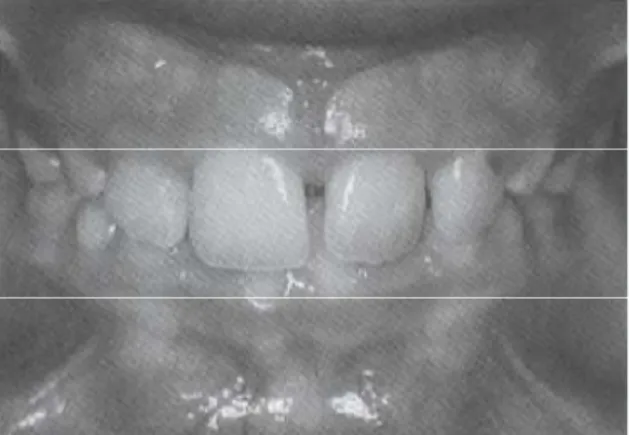 Gambar  4:  Deep bite  anterior. (Sumber  :  Bishara.  Samir  E.  Textbook  of  Orthodontics