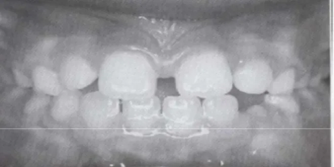 Gambar 7: Diastema ((Sumber : Bishara. Samir E. Textbook of Orthodontics. W.B Saunders Company