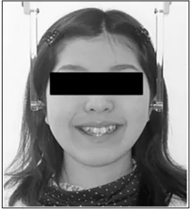 Gambar  2.  Pasien  dengan  deviasi  mandibula  dalam  arah  transversal. 39    