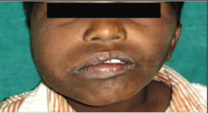 Gambar  5.  Profil  pasien  Hemifacial  Hypertrophy. 44    