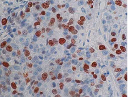Gambar : Ki-67 positive staining in an early relapsing breast cancer, magnification × 400