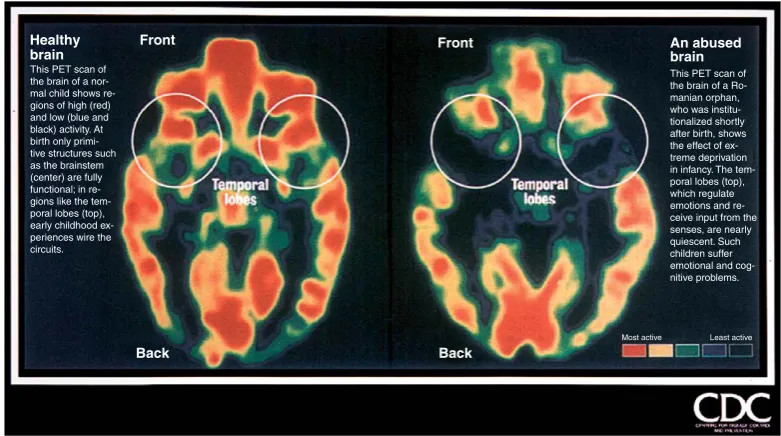 Figure 2Effects of maltreatment on brain structures. Reproduced from the CDC website.