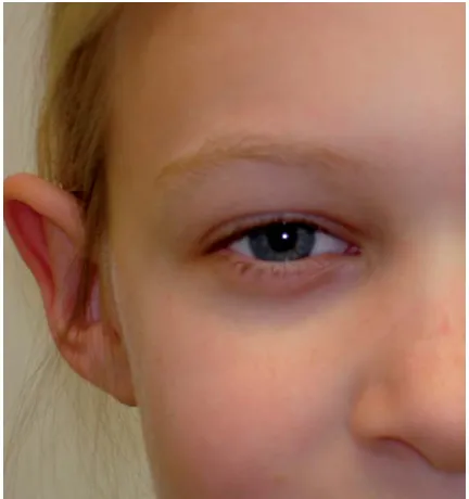 Figure 2Allergic shiners in a child with perennial allergicrhinitis. Reproduced with permission from the parent.