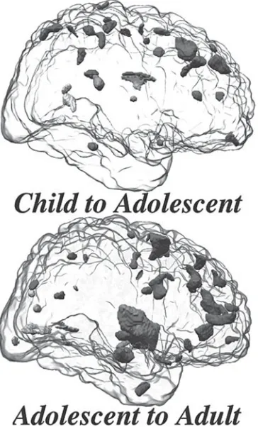Figure 3-1 Top,ing gray matter density reductions observed between childhood and adolescence; adolescence and adulthood