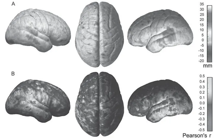 Figure 3-13 A, gray matter group-difference maps showing differences in gray matter density (percent difference) between the ADHD and control sub-jects according to the color bar on the right
