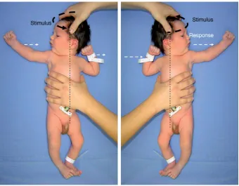 Figure 9The asymmetrical tonic neck reflex.