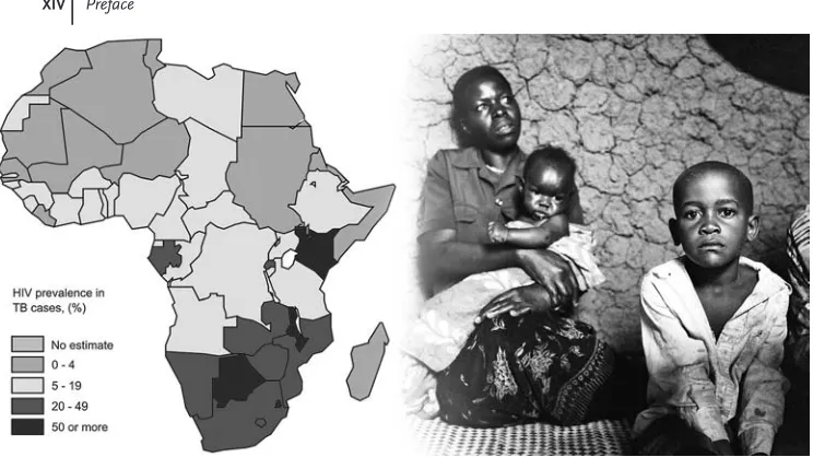 Figure 1 (left) Estimated HIV prevalence (as %) among new TBcases in Africa, 2006. Source: WHO Global tuberculosis control:surveillance, planning, financing (2008); (right) AIDS–TB pa-tients in Uganda