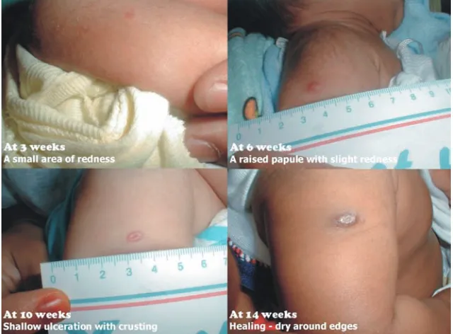 Figure 3.1 Normal evolution of the local skin reaction following intradermal vaccination with BCG.
