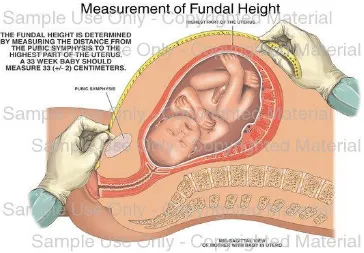 Gambar 1. Cara pengukuran tinggi fundus uteri. 