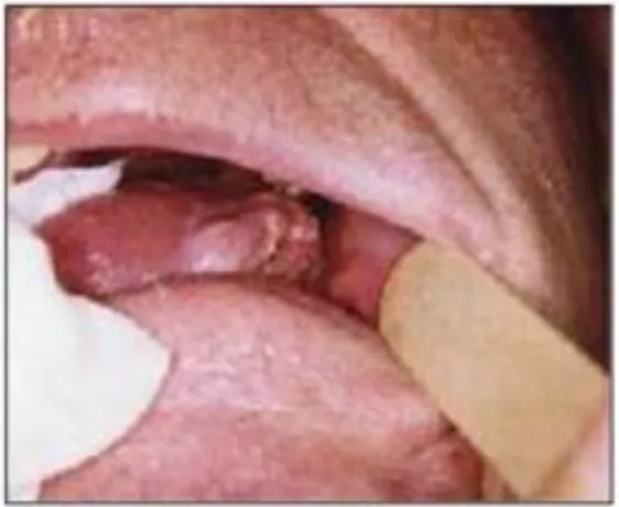 Gambar 3. Terlihat ulser pada sisi lateral lidah dengan sel skuamus karsinoma pada penderita laki-laki berumur 80 tahun yang merupakan perokok dan peminum alkohol berat.12 
