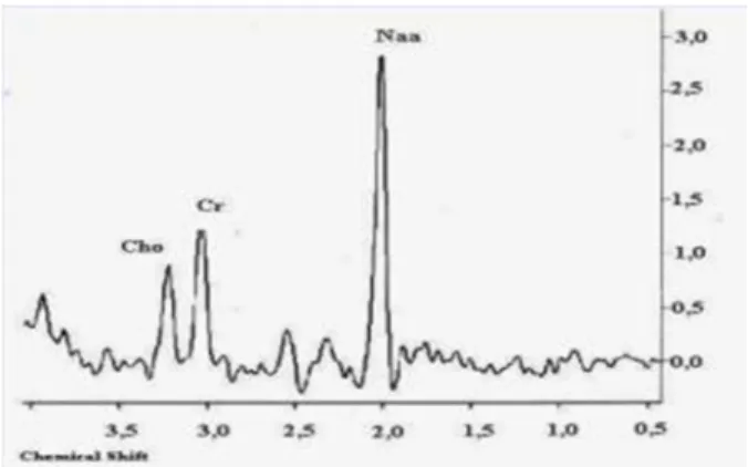 Gambar 4. Proton MR Spectroscopy Otak Normal (Irina, 2008) 