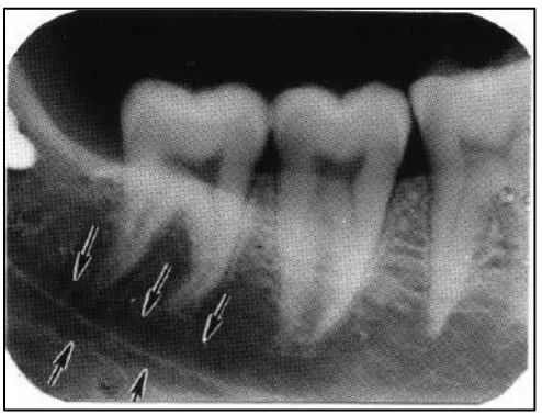 Gambar 5. Kanal Mandibula3 