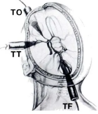 Gambar 3. Posisi transduser pada ke-4 window. A. transtemporal, B. transorbital, C. suboccipital, dan D