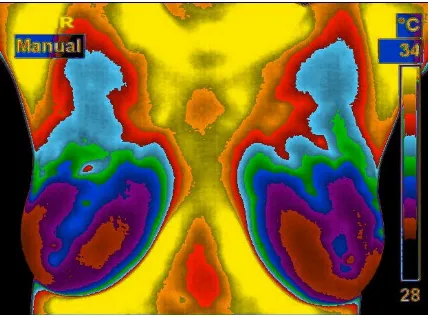 Gambar 2. Citra inframerah payudara dengan abnormalitas. 