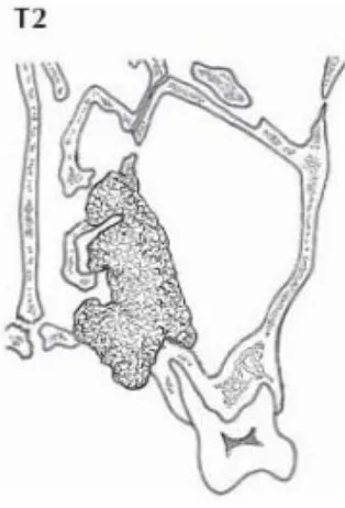Gambar 2.3.  T1 terbatas pada mukosa sinus maksilaris (Greene, 2006). 
