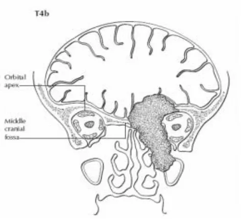 Gambar 2.7.  Pandangan koronal T4b menunjukkan tumor menginvasi apeks 
