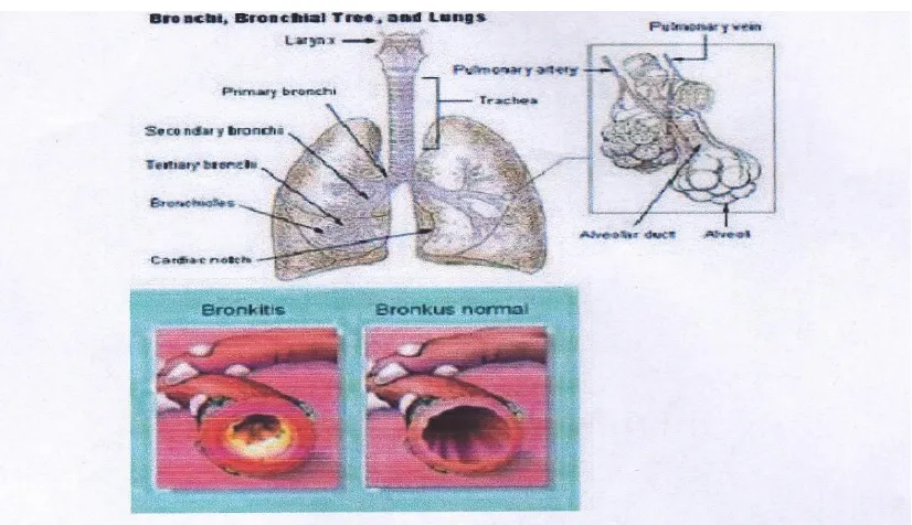 Gambar 2.1. Menunjukkan perbedaan bronkus normal dan bronkitis Sumber: http//www.medicastore.com/penyakit/14/bronkitis.html 