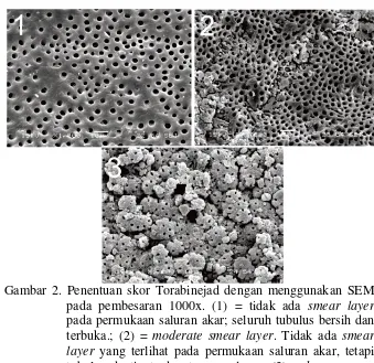 Gambar 2. Penentuan skor Torabinejad dengan menggunakan SEM pada pembesaran 1000x. (1) = tidak ada smear layer pada permukaan saluran akar; seluruh tubulus bersih dan terbuka.; (2) = moderate smear layer