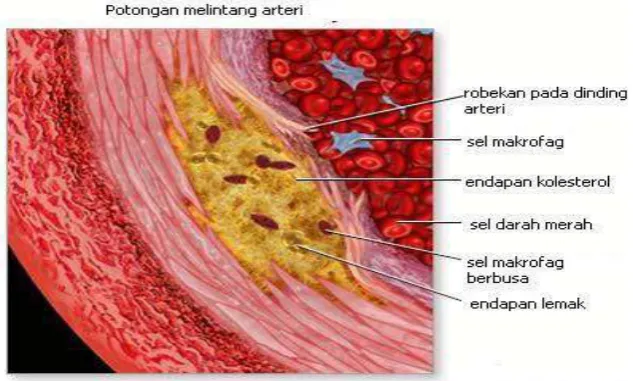 Gambar 2.2. Potongan Melintang Arteri pada Aterosklerosis 
