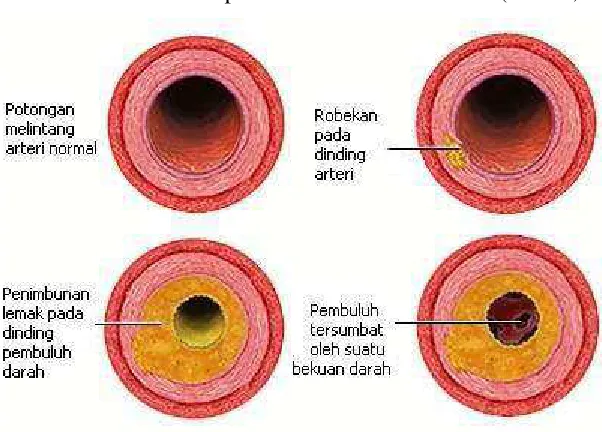 Gambar 2.3. Proses Terjadinya Sumbatan pada Arteri 