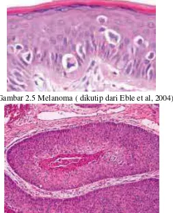 Gambar 2.5 Melanoma ( dikutip dari Eble et al, 2004) 