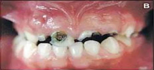 Gambar 5. Destruksi gigi insisivus maksila dengan abses gigi  