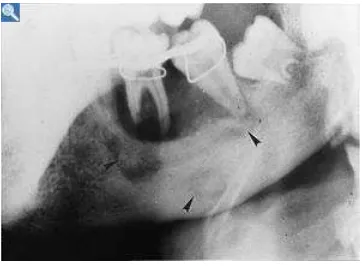 Gambar 1. Osteomielitis kronis pada  rahang.(http://www.medcyclopaedia.com/library/radiology/chapter11/11_4.aspx) (6 Februari 2010) 