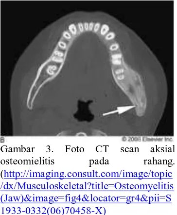 Gambar 2. Foto MRI osteomielitis pada  rahang (http://imaging.consult.com/image/topic