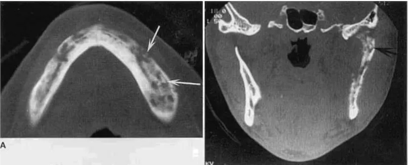 Gambar 4. Foto CT Scan sequester pada rahang. a. Foto aksial CT scan menunjukan adanya multipel sequester b