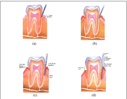 Gambar 2. Tahapan penyakit periodontal 26 