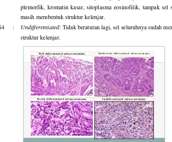 Gambar 2.7.1  Differensiasi sel Adenokarsinoma (National Cancer Center 