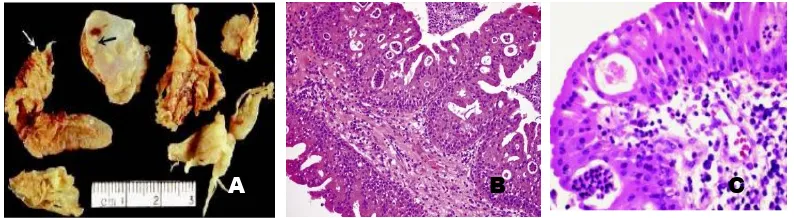 Gambar 2.4 Oncocytic papilloma. A. Gambaran makroskopis, tampak pertumbuhan exophytic  (panah putih) dan inverted (panah hitam)