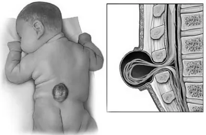 Gambar 2.1. Spina Bifida22 