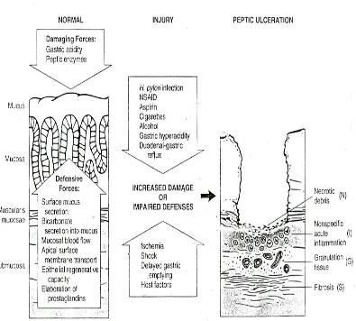 Gambar 2.4. Penyebab dan  mekanisme pertahanan dan ulkus peptik 