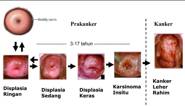 Gambar 9. Perjalanan alamiah penyakit kanker leher rahim 