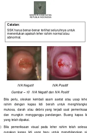 Gambar – 10  IVA Negatif dan IVA Positif 