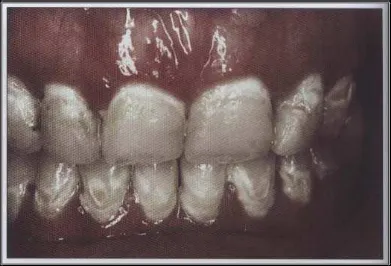 Gambar 2. Erosi gigi akibat tingginya frekuensi konsumsi minuman yang mengandung karbonat.1 