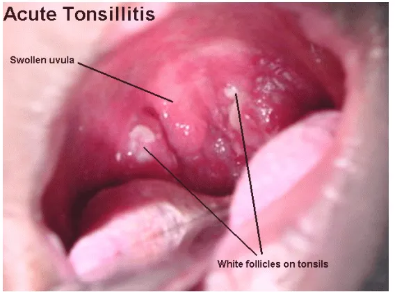 Gambar 2.2. tonsilitis akut 